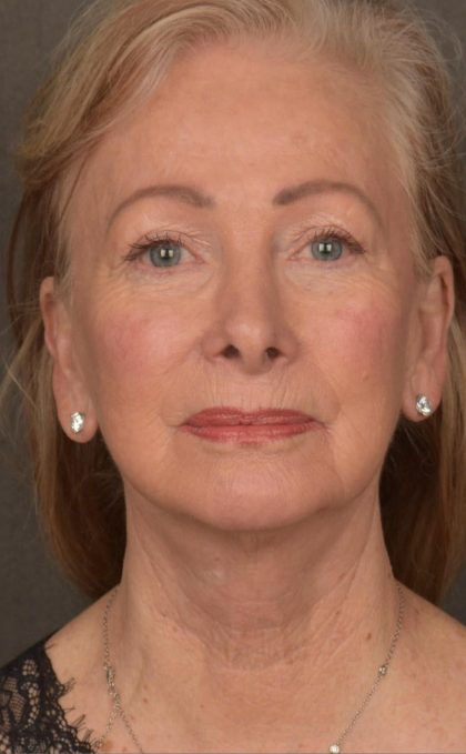 Facelift Before & After Patient #2867