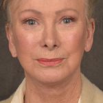 Facelift Before & After Patient #2867