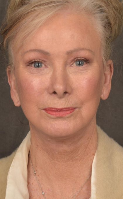 Facelift Before & After Patient #2867