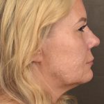 Facelift Before & After Patient #2876