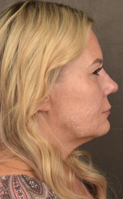 Facelift Before & After Patient #2876
