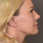Facelift Before & After Patient #2876