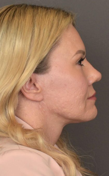 Facelift Before & After Patient #2876