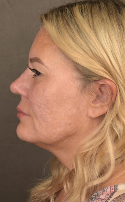 Facelift Before & After Patient #2876