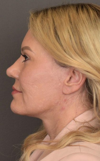 Facelift Before & After Patient #2876