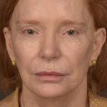 Facelift Before & After Patient #2879