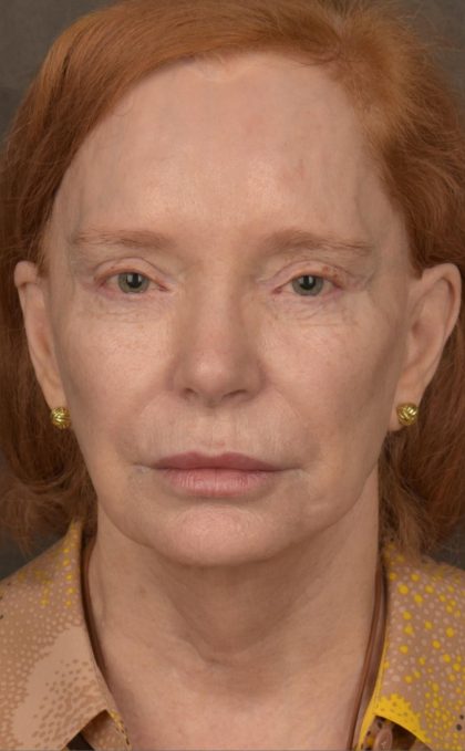 Facelift Before & After Patient #2879