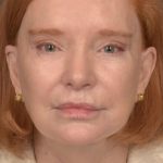 Facelift Before & After Patient #2879