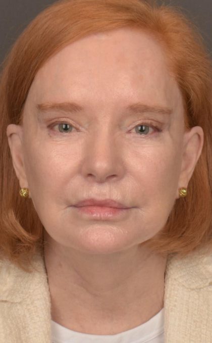 Facelift Before & After Patient #2879