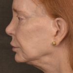 Facelift Before & After Patient #2879