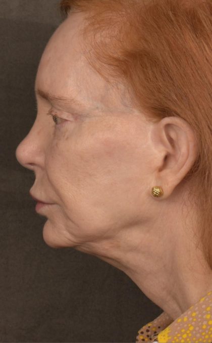 Facelift Before & After Patient #2879