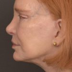 Facelift Before & After Patient #2879