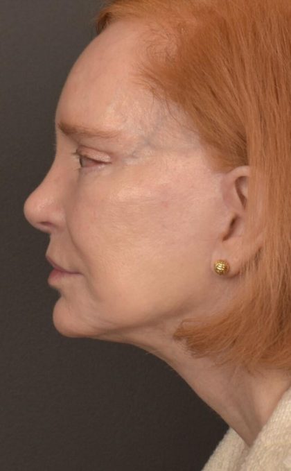 Facelift Before & After Patient #2879