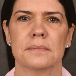 Facelift Before & After Patient #2880