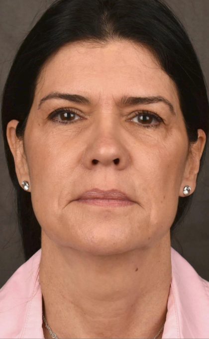 Facelift Before & After Patient #2880