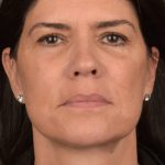 Facelift Before & After Patient #2880