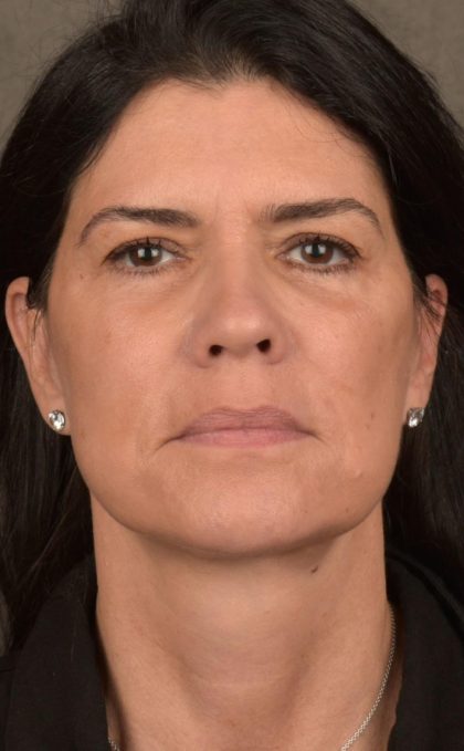 Facelift Before & After Patient #2880
