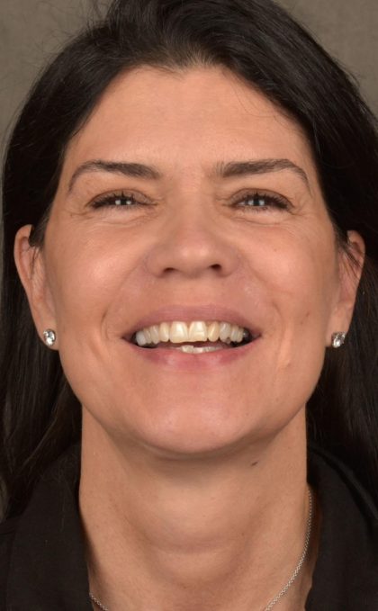 Facelift Before & After Patient #2880