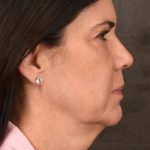 Facelift Before & After Patient #2880