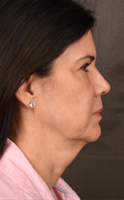Facelift Before & After Patient #2880