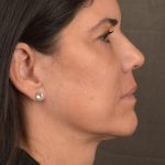 Facelift Before & After Patient #2880