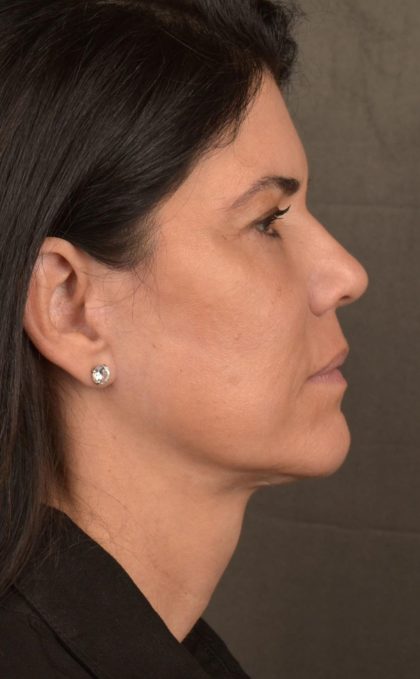 Facelift Before & After Patient #2880