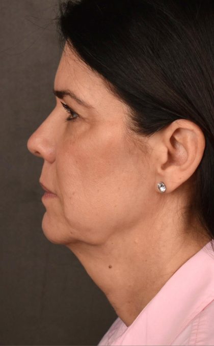 Facelift Before & After Patient #2880