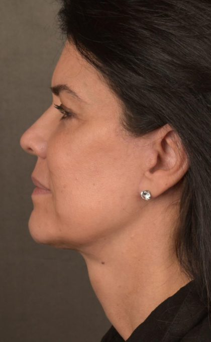 Facelift Before & After Patient #2880