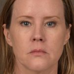 Facelift Before & After Patient #2881