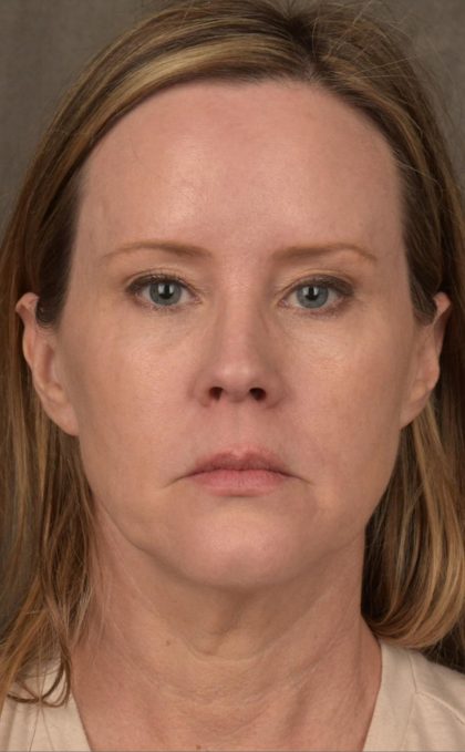 Facelift Before & After Patient #2881