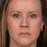 Facelift Before & After Patient #2881