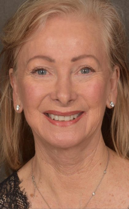 Facelift Before & After Patient #2867