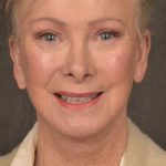 Facelift Before & After Patient #2867
