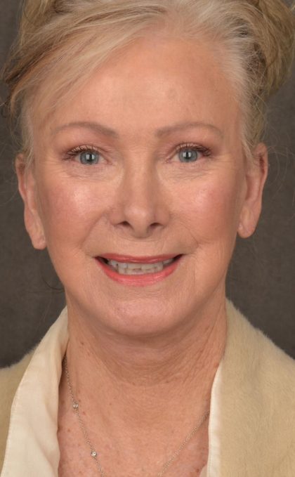 Facelift Before & After Patient #2867
