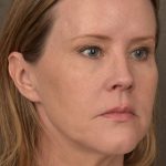 Facelift Before & After Patient #2881