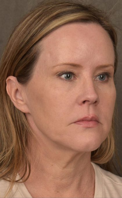 Facelift Before & After Patient #2881