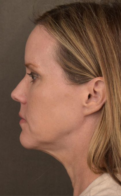 Facelift Before & After Patient #2881