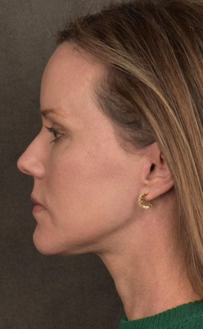 Facelift Before & After Patient #2881