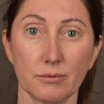 Facelift Before & After Patient #2882