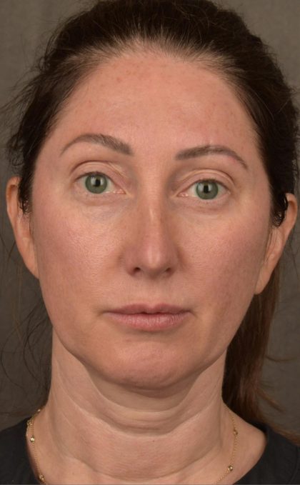 Facelift Before & After Patient #2882
