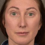 Facelift Before & After Patient #2882