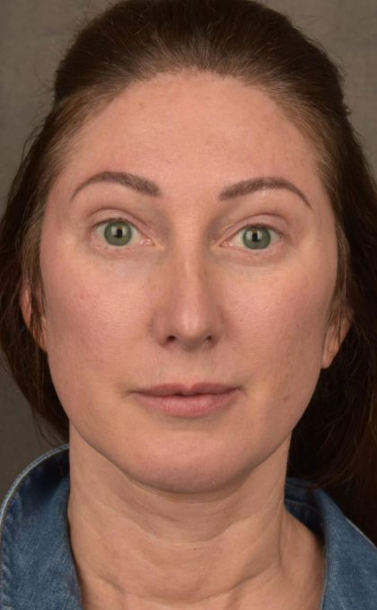 Facelift Before & After Patient #2882