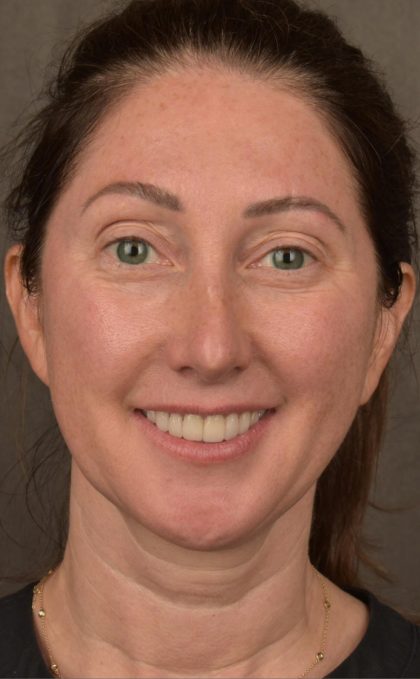 Facelift Before & After Patient #2882