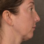 Facelift Before & After Patient #2882