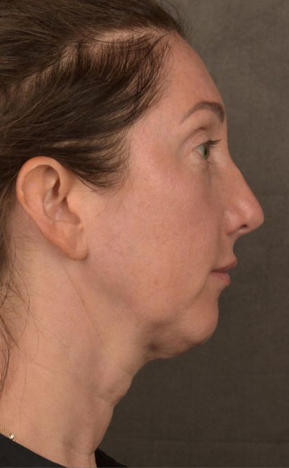 Facelift Before & After Patient #2882