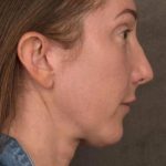 Facelift Before & After Patient #2882