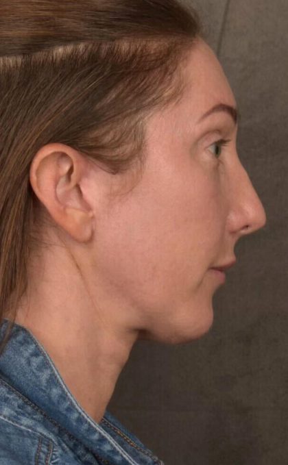 Facelift Before & After Patient #2882