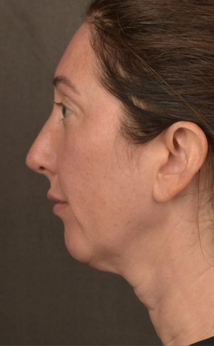 Facelift Before & After Patient #2882
