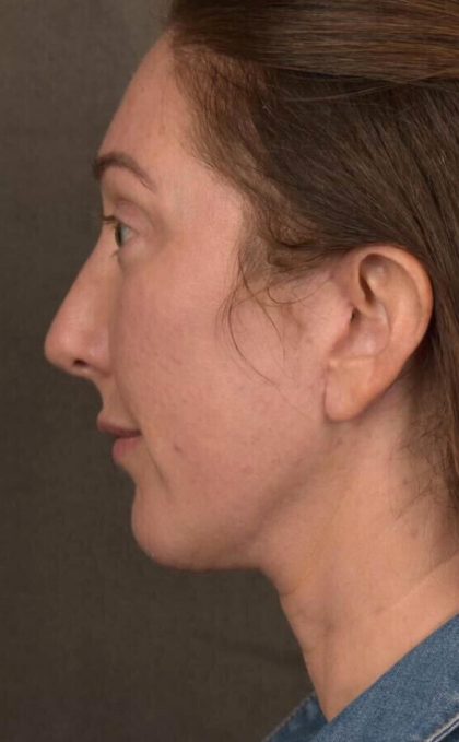 Facelift Before & After Patient #2882