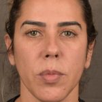 Facelift Before & After Patient #2883